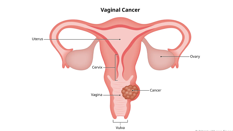 Kanker Vagina: Tanda-tanda dan Pencegahan dari PAFI Magetan